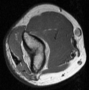 Figure 4 for case Osteoid Osteoma
